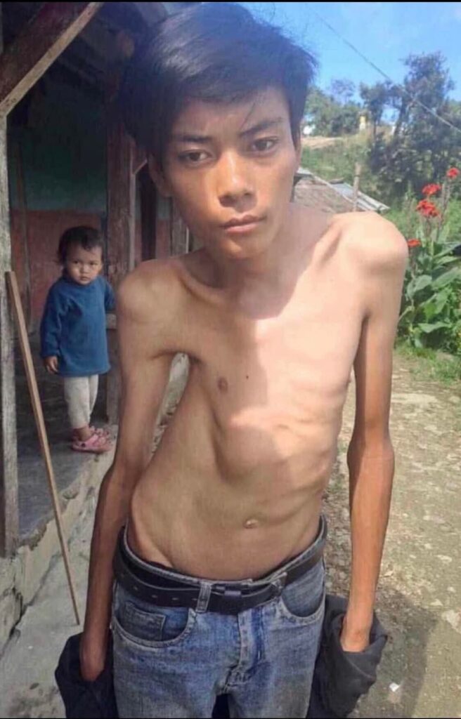 चितवन इच्छाकामना निवासी गोकुल गुरूंगको जटिल शल्यक्रिया: आर्थिक सहयोगका लागि अपिल 3 FB IMG 1742185901644